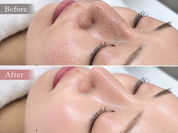 レイ エステティック 江南店(RAY ESTHETIC)の写真/肌質改善を目指す方へ。透明感あふれる素肌美人に