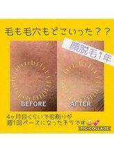ビシル(Bishiru.)/顔脱毛12ヶ月20回ビフォアフター