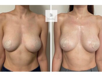 エムクリニカルラボ 藤沢(M clinical lab)/脂肪増加剤導入バストケア