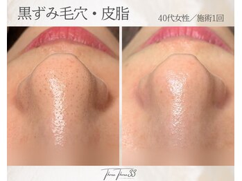 スリースリー(THREE THREE)/毛穴黒ずみ・詰まりケア