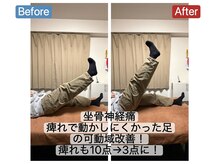 アンティオール 札幌店/30代男性　お尻～足の痺れ