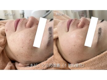 ミュー 春日井店(mieux)/◆肌質改善例