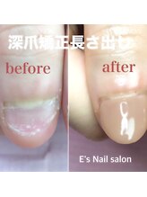 イーズ(E's)/深爪矯正長さ出し