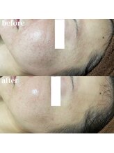 ナチュレ(Nature)/ハーブピーリングbefore→after