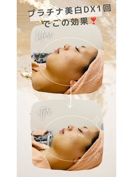 アニー(Annie)/毛穴!美白!むくみ!肩首コリ!