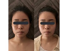 ハイコガオ(HIKOGAO)/小顔矯正40分