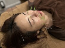 中野パーソナル整体院/美容鍼（顔、デコルテ）