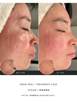 ノイ(noi.)/リジュランピール(snow peel)