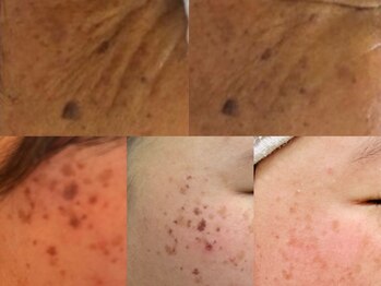 ゼロ(ZERO)の写真/お肌悩みに優れたパワーを発揮するBBLフェイシャルでシミしわ改善!ヒト幹細胞パックなどパックが選べる☆