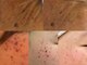 ゼロ(ZERO)の写真/お肌悩みに優れたパワーを発揮するBBLフェイシャルでシミしわ改善!ヒト幹細胞パックなどパックが選べる☆