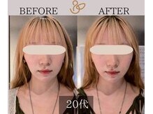 チョコバリ 新宿店(chocobari)/小顔×リフトアップ(美容鍼)20代