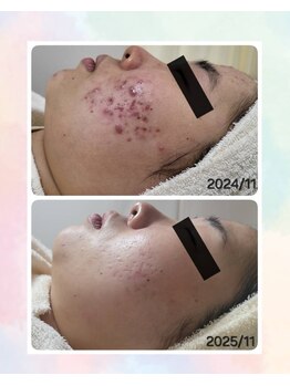 レゾン 京橋店/【Before/after】ニキビケア