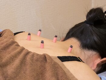 いなほ はりきゅう整骨院 東新宿/鍼灸(吸い玉併用)コース