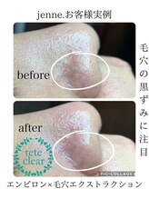 ジェンヌ(jenne.)/毛穴エクストラクション