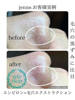 ジェンヌ(jenne.)/毛穴エクストラクション
