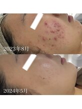 エステサロンブランシュ(Esthe salon Blanche)/ハーブピーリングでニキビケア