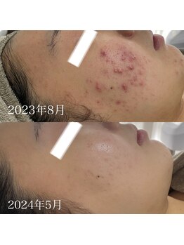 エステサロンブランシュ(Esthe salon Blanche)/ハーブピーリングでニキビケア