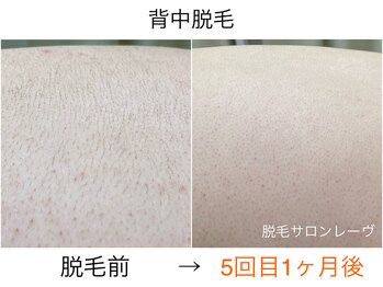 レーヴ/手の届かない所は脱毛がオススメ