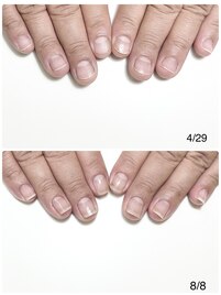 自爪育成3ヶ月コース