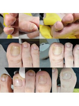 【肥厚・変形爪】ネイル/フット