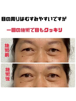 哲心 姫路/初回施術で目の周りもスッキリ！