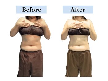 ビオラス 太田店/４回でおへそ周りのしわ改善30代