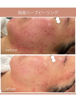 シャンディ(Shandy)/人気のハーブピーリング