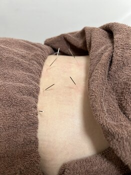 陽月 鍼灸院整骨院の写真/美容鍼や、季節ごとの身体のケア、女性特有のお悩みなど女性鍼灸師による完全個室での施術です♪