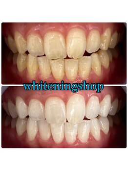 ホワイトニングショップ 吉祥寺店/BEFORE ＆ AFTER