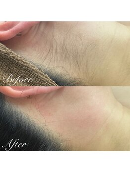 マテオ(Matteo)/うなじワックス+SHR脱毛