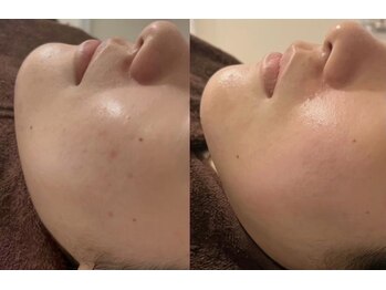 エト(eto.)/ニキビケア