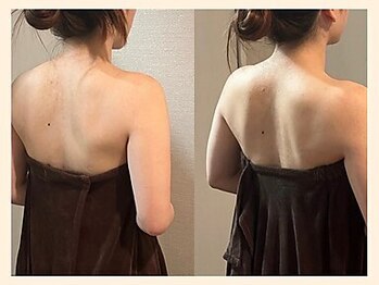 【肩こり/リンパマッサージ/小顔/ヘッドスパ】肩甲骨はがし肩こり整体RUFFREE高尾院/肩甲骨のシルエットが劇的改善