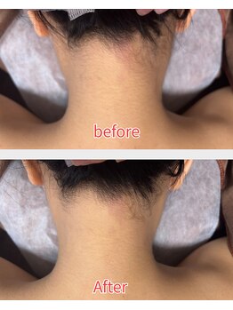 フェリーチェ 大塚店(Felice)/真後ろもキレイ★うなじ脱毛