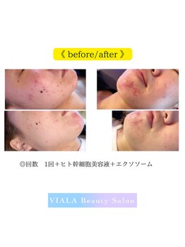 ビアラ(VIALA)/プラズマのBefore/After