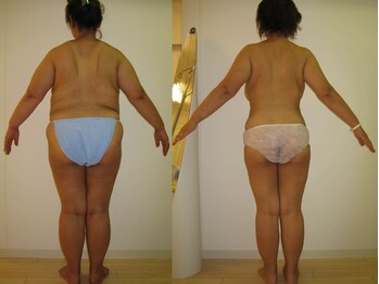 ジオリッチシフォン(giorich chiffon)/リジュべネーション全身10回