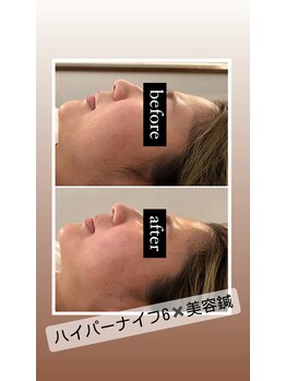 みずわき治療院/ハイパーナイフ6×美容鍼