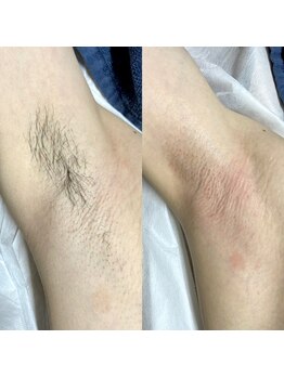 ヒスイ バイ アメイジング(Hisui by AMAZING)/【ワックス脱毛】男性脇　