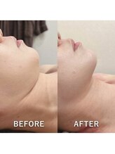 ブランシュムーニー(BRANCHE MOONY)/顎下のお肉が！！！