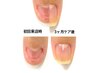 3ヶ月で縦長爪に。爪の悩み解決集中コース1回/60分/計8回/ホームケア込み