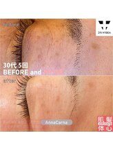 アンナカルナ(AnnaCarna)/変化するから楽しいプラズマ美容