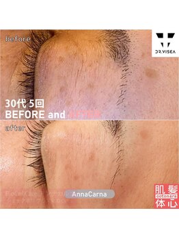 アンナカルナ(AnnaCarna)/変化するから楽しいプラズマ美容