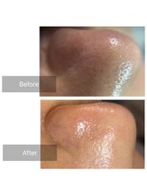 アンド リュクス(& Luxe)/エクストラクションで毛穴クリア