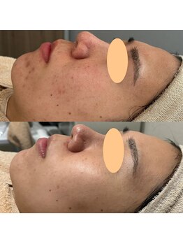 ミリミリ(mili mili)/ハーブ＋プラズマ