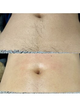 ヒスイ バイ アメイジング(Hisui by AMAZING)/【ワックス脱毛】男性腹部