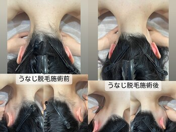 るあん/美肌脱毛