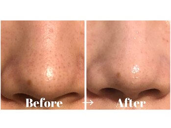 カラーリリー アンド ユン(Calla lily & yun)/ハイドラ毛穴洗浄でキレイに♪