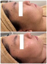 ヤワラ 長与店(yawara)/毛穴洗浄