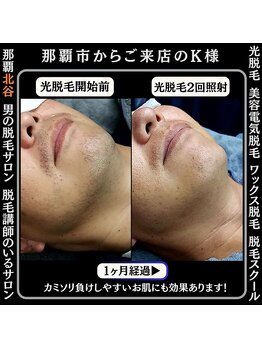 メンズディースタイル 首里店(Men's Dstyle)/那覇メンズ脱毛ヒゲBefore after