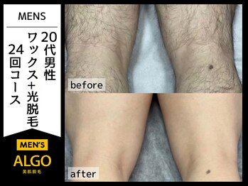 アルゴ 小松店(ALGO)/部分脱毛も★（30代男性）