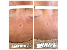 エメリア(Emelia)の雰囲気(ダクトピール×シミケア♪)